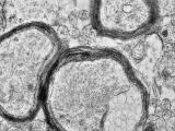 Glia in Diseases