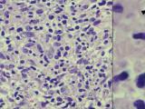 Leishmania in Clinical Sample