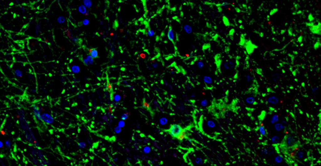Polyglucosans (insoluble glycogen) in the brain of human patient (in red)