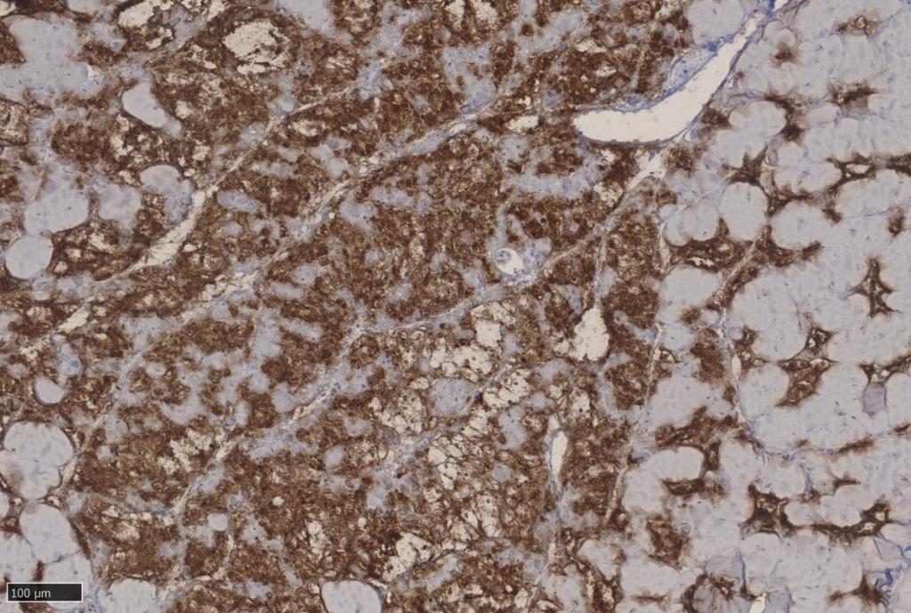 Myo-macrophagy (macrophage invasion of muscle) as indicated by brown staining