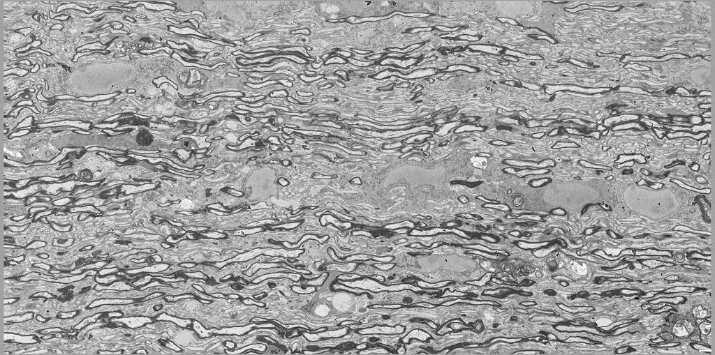  myelin whorls