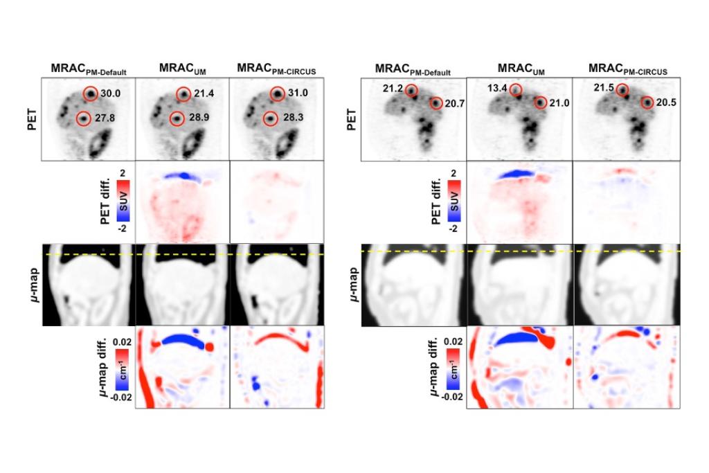 PET/MRI attenuation correction comparison across MRAC methods.