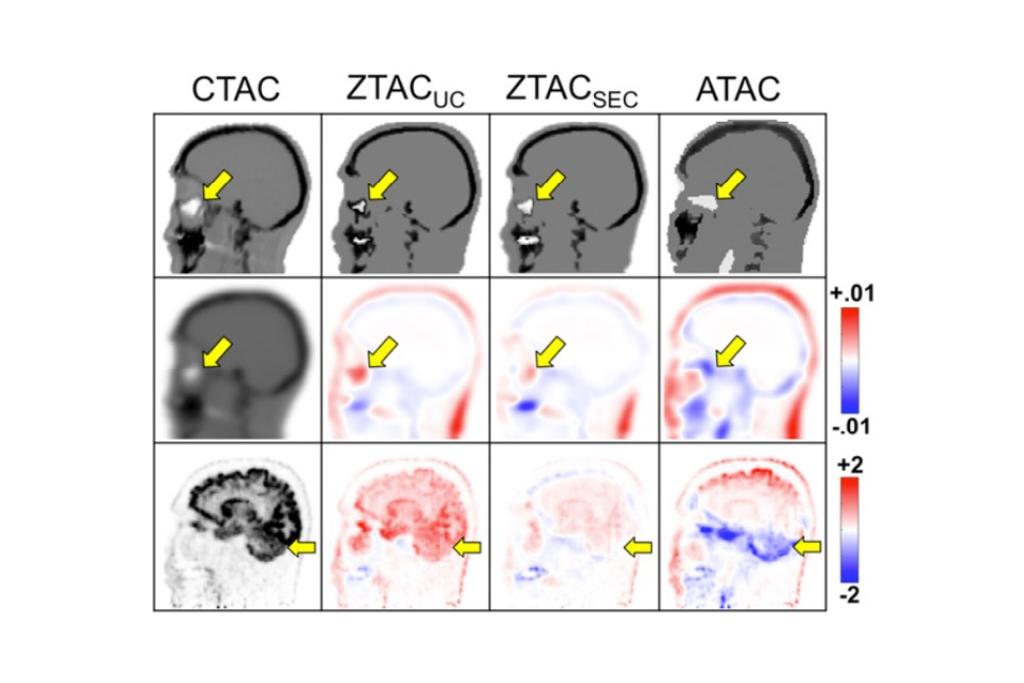 PET/MR attenuation correction comparison of CTAC, ZTAC, and ATAC methods.