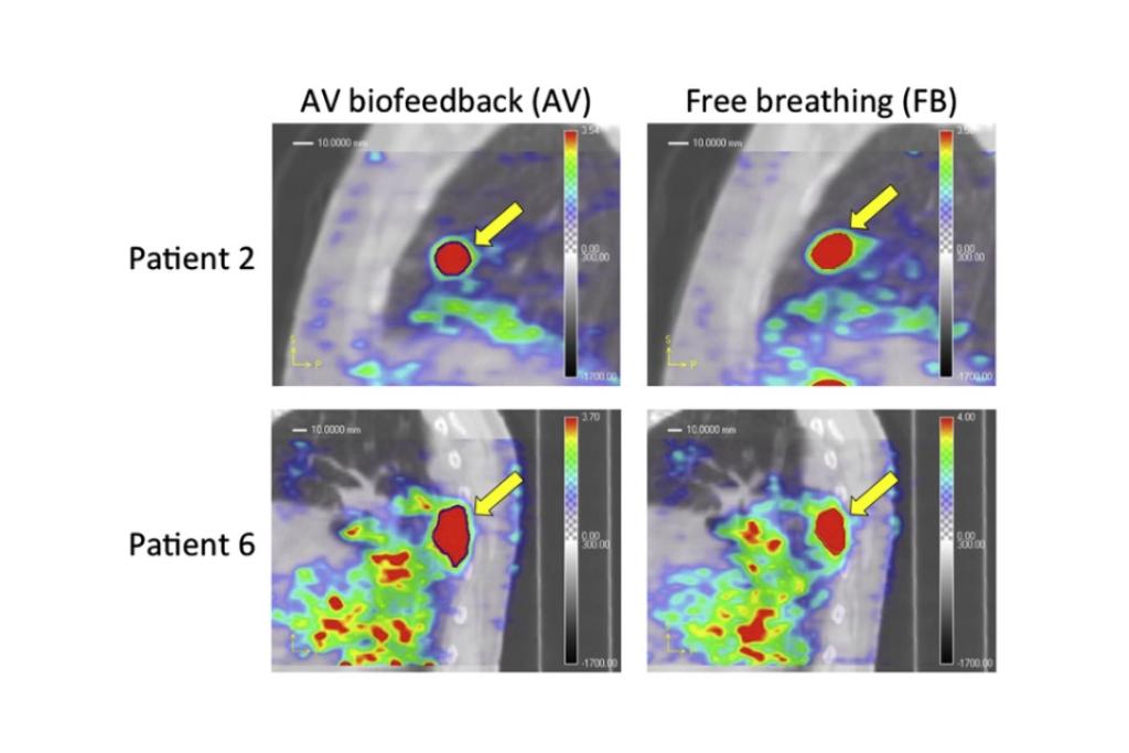 PET imaging comparison using AV biofeedback and free breathing.