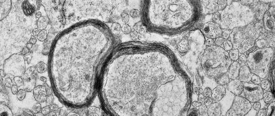 Glia in Diseases