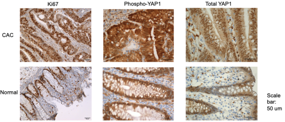 Ki67, pYAP, and tYAP staining in Colitis-Associated Cancer versus Normal Tissue