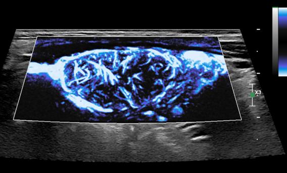 Micro-Doppler flow of kidney