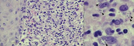 Leishmania in Clinical Sample