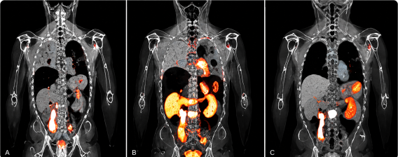 PSMA PET/CT imaging of prostate cancer shown in three side-by-side coronal scan views, with highlighted areas of radiotracer uptake in orange and yellow.