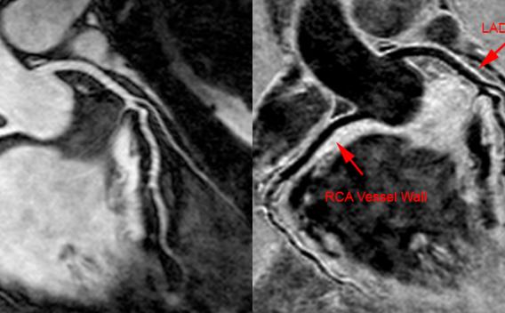 Vessel wall imaging using CMR