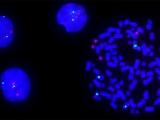 aneuploidy